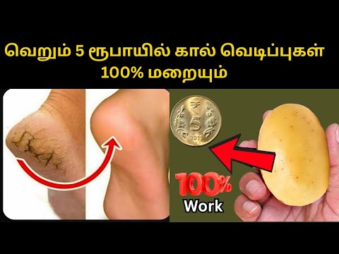 வெறும் 5 ரூபாயில்கால்வெடிப்புகள்100% மறையும்100%Live Result#feet #heelpain #crackedheels #beautytips