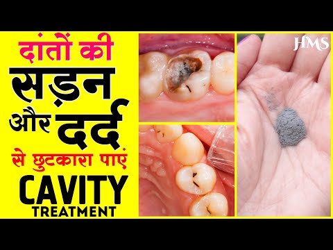 दांतों की सड़न और दर्द से छुटकारा पाएं | Tooth Cavity & Pain Natural remedies