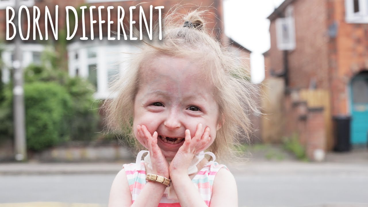 The only girl in the world with 'benjamin button' disease - born different