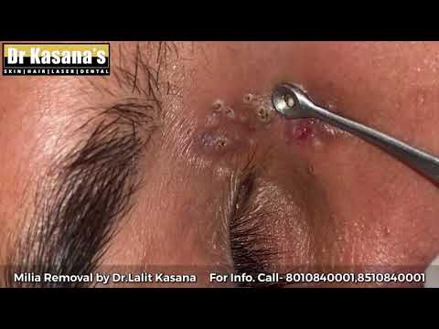 Blackheads & Milia Removal by Dr.Lalit Kasana