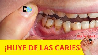 ¡Dile adiós a las caries con estos trucos diarios!