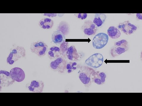 YouTube video thumbnail: Brain-Eating Amoeba Case in Missouri