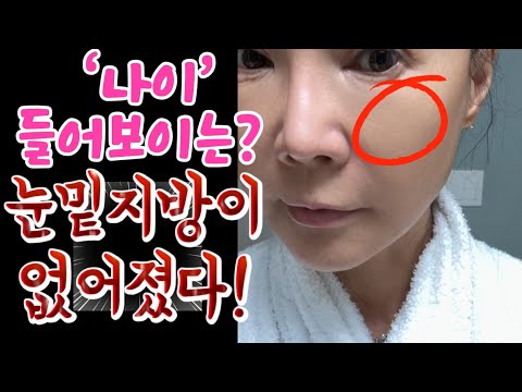 눈밑 지방 고민이시면 꼭 보세요 !!👀얼굴이 완전 팽팽해졌어요 ✨