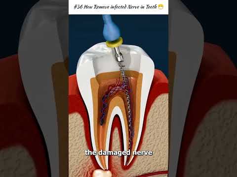 Infected Nerve Removal in Tooth ๐จ #shorts