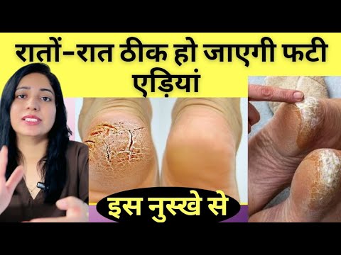 फटी हुई  एड़ियों से छुटकारा पाने का बेस्ट घरेलू नुस्खा | Cracked Heels Home Remedy |