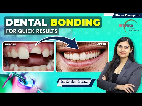 DENTAL BONDING for Broken Tooth, Teeth Gap: Dr. Srishti Bhatia #composite #veneers #smilemakeover