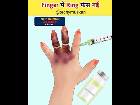 Finger में Ring फंस गई 😲 #asmr #shorts