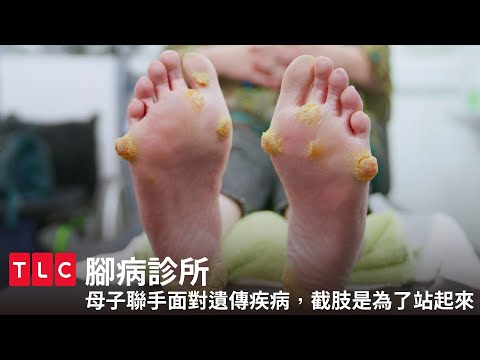 就算要截肢也沒關係😭遺傳性疾病找上門，母子一同求醫改善生活！｜腳病診所｜TLC 旅遊生活頻道