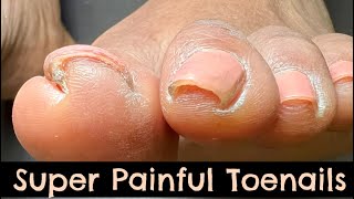 EXTRACTION OF SUPER PAINFUL INCURVATED TOENAILS!