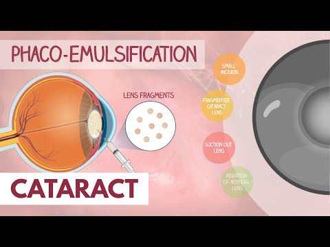 Cataract | Dr. Paulien Moyaert