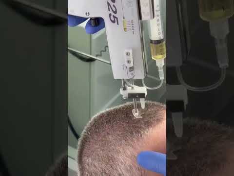 Cette technique aide à lutter contre la calvitie