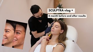 Sculptra (face) before & after + my experience | VLOG