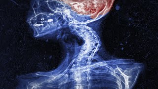 A Mom Did Chiropractic Maneuver On Her Own Neck. This Is What Happened To Her Brain.