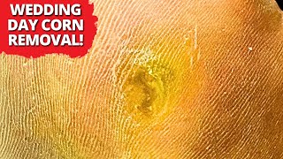 He Can’t Walk Down the Aisle With THIS on His Foot! 😱 Satisfying Foot Transformation