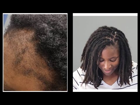 HOW TO AVOID TRACTION ALOPECIA