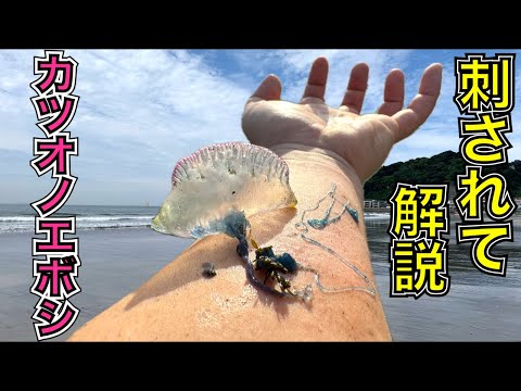 【実演】カツオノエボシに刺されるとこうなります