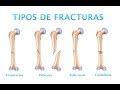 Tipos y Características de Fracturas