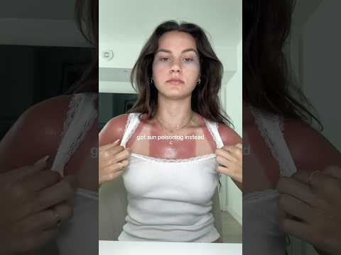 wanted to feel something #sunburn #summer #sun #sunpoisoning #skincare #skin #burn #miami #florida