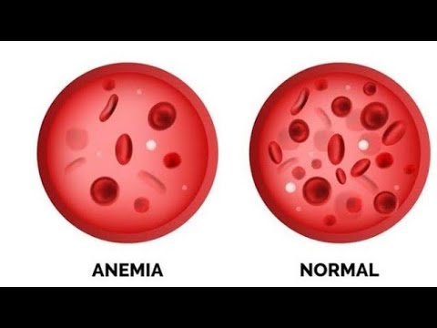 Home remedies to increase hemoglobin level