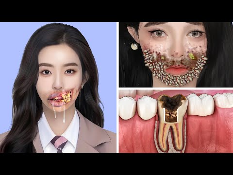 EXTREME ASMR Removal of Maggots and Dogticks Infected Dirty Mouth!