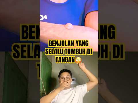 Benjolan yang bisa tumbuh di tangan😳 #science #experiment #thebaldheadnthedreadpodcast #doctor