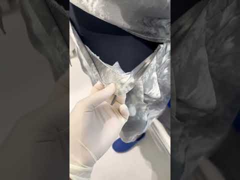 ช็อค! เห็นไขมันตัวเอง ถึงกับอุทานว่ากินอะไรเข้าไป! ดูดไขมันเทคนิค X-Shape Liposuction #theklinique