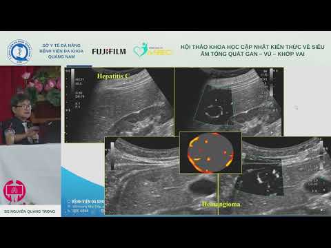 [S] Siêu âm vi mạch đánh giá bướu gan (BS Nguyễn Quang Trọng)