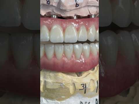 Hybrid, All-On-X, Zirconia restoration