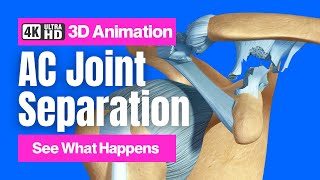 AC Joint Separation - 4K 3D Animation