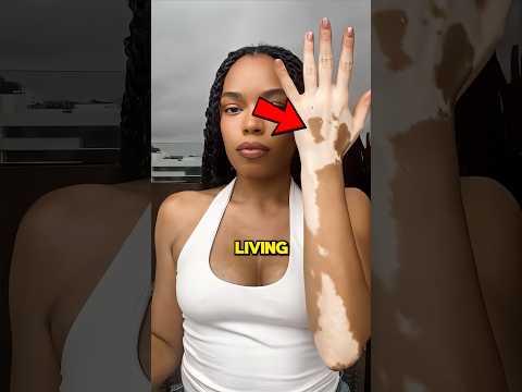 Embracing Vitiligo Art (@amara_artspots) 🌸