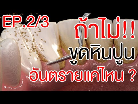 ถ้าไม่ขูดหินปูนอันตรายแค่ไหน ? | EP.2/3 | โชคช่วย กับหมอโชค