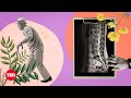 Understanding Back Pain