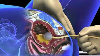 Foley catheter insertion procedure in females: 3d animation