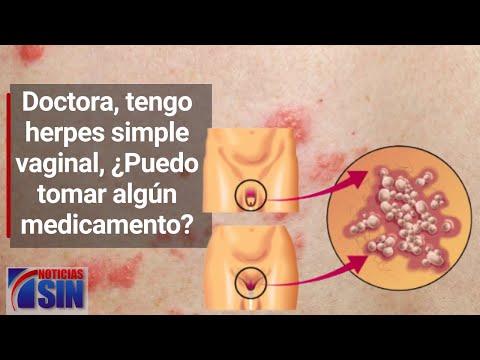 Doctora, tengo herpes simple vaginal, ¿Puedo tomar algún medicamento para prevenir los brotes?