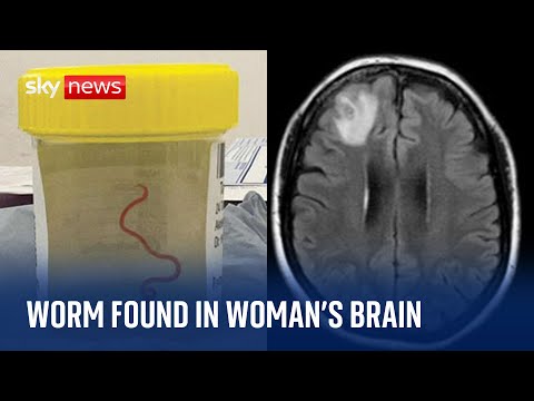 Live worm found in woman's brain in world-first discovery