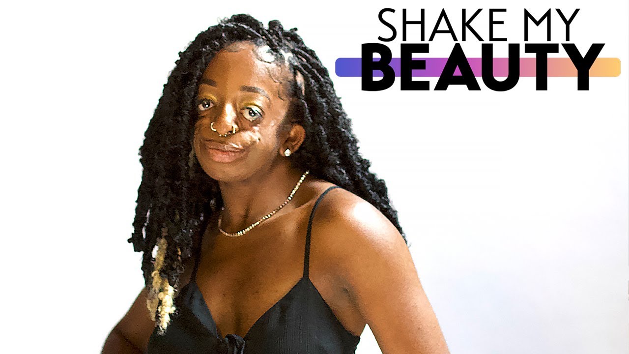 Treacher collins syndrome won't stop me modelling - shake my beauty