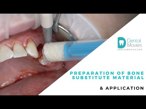 Preparation of bone substitute material & application