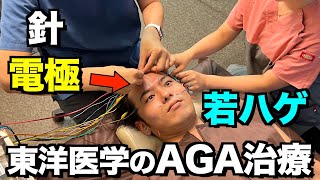 【AGA治療】若ハゲが頭皮に電流を流してみた