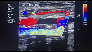 Occlusion of superficial femoral artery, lower limb  arterial duplex scan.