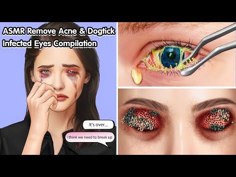 ASMR Remove Acne & Dogtick Infected Eyes Compilation - Deep Cleaning Animation