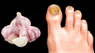 🔥 Schnell frei von Nagelpilz! Bestes Hausmittel gegen Pilze & Parasiten: Knoblauchkraft 💯