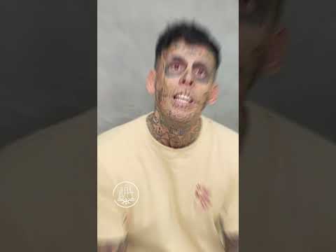 Retorno do nosso paciente Leandro | Remoção de Tatuagem