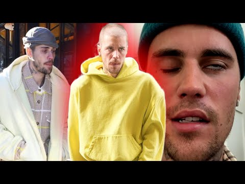 ¿Que está pasando con Justin Bieber? Así se ve Justin Bieber en los últimos años.