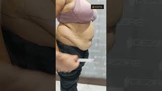 Tummy Tuck marking
