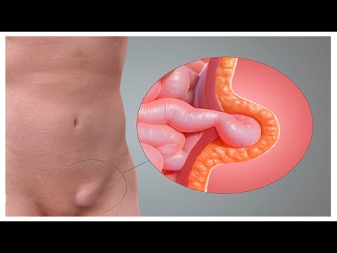 Que son las Hernias Inguinales - HogarTv por Juan Gonzalo Angel
