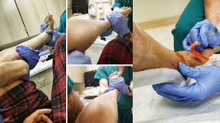 CLOSED REDUCTION ANKLE FRACTURE ALIGNMENT