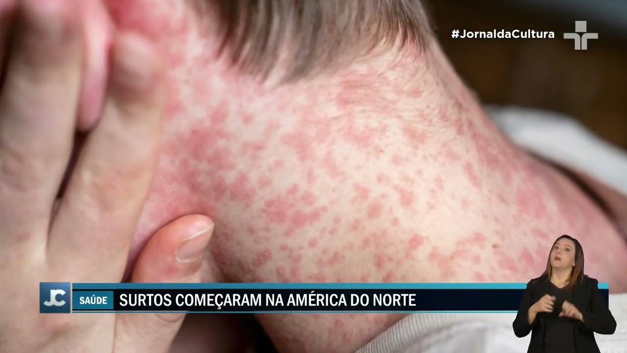 Casos de sarampo aumentam 34 vezes nas Américas em 2025