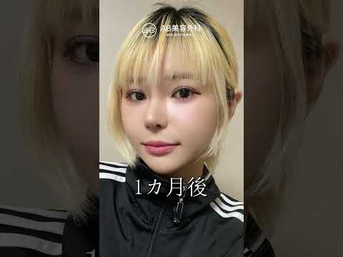 【韓国整形】目整形・鼻整形・顔面輪郭整形で韓国アイドル級の垢抜け完成♥️ #韓国整形 #shorts
