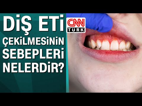 Diş eti çekilmesinin sebepleri nelerdir?