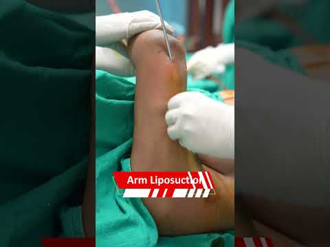 Arm Liposuction #shorts #ytshort